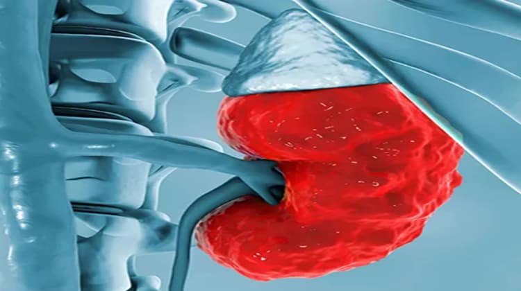 Enfermedad renal crónica