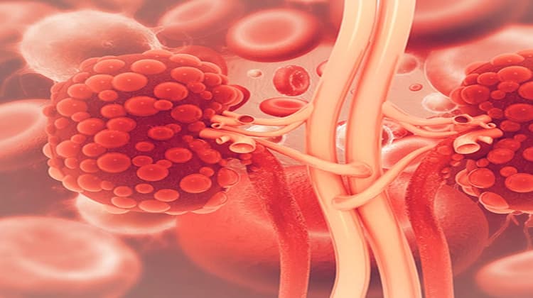 Enfermedad renal poliquística (ERP)