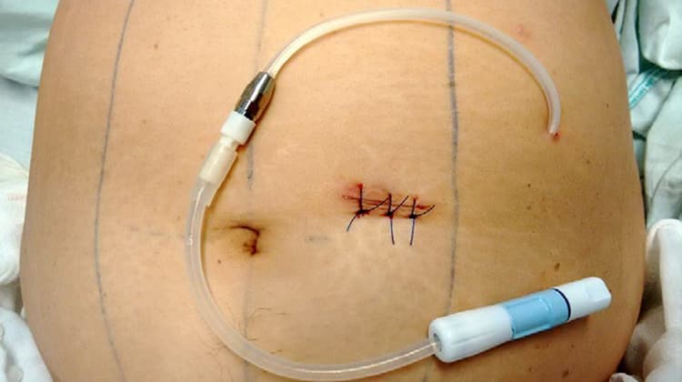Diálisis peritoneal