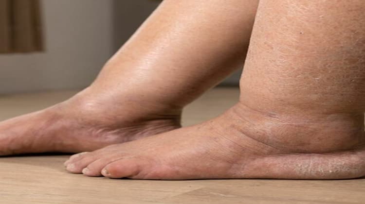Edema (hinchazón)