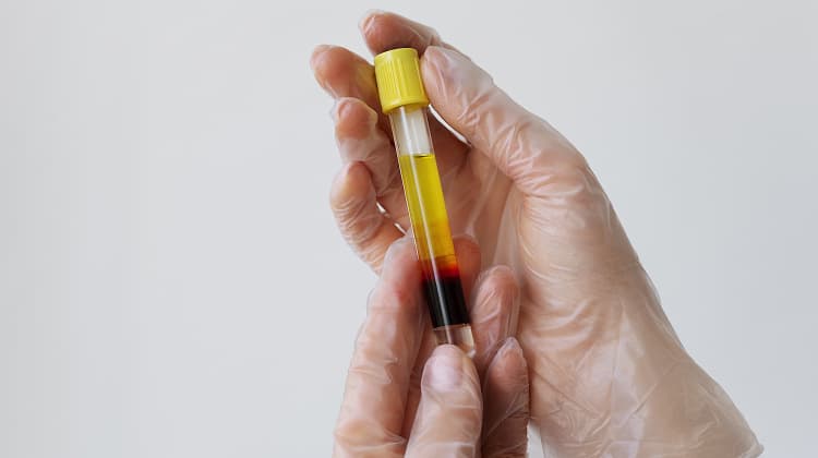 Hematuria (Sangre en la orina)
