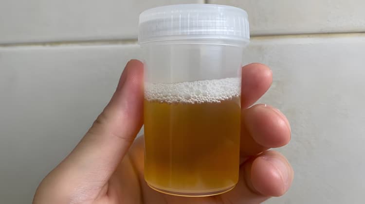 Proteinuria (presencia de proteínas en la orina)